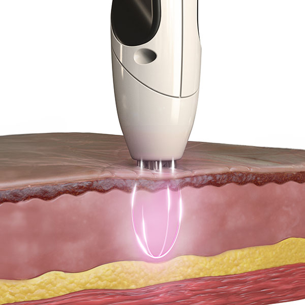 Divine Pro TriPollar